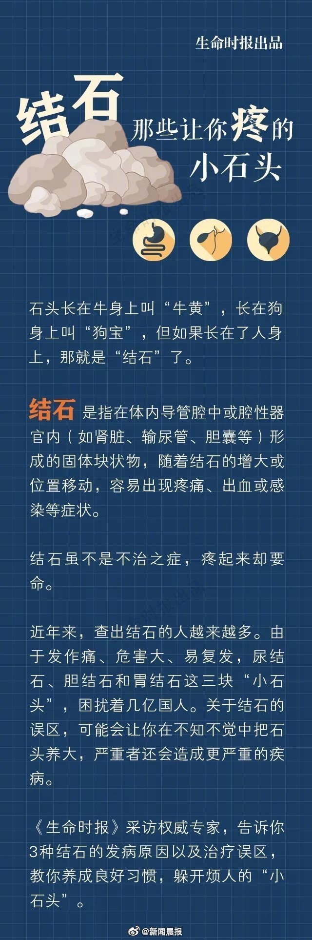 男子排尿疼痛取出鹅蛋大的结石男性结石男子结石到达尿道口不出怎么办