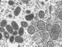 猴痘病毒跟天花的根本区别是什么 猴痘的传染性和致死率介绍