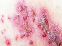 带状疱疹在肛周,带状疱疹对患者的危害有哪些
