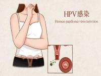 ȾHPV52ô_hpv52ôȾ